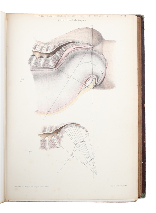 Atlas de L'Art des Accouchements. Continué par Marc Sée (et) S. Tavernier. Ouvrage contenant 105 Planches avec Texte Explicatif en Regard.