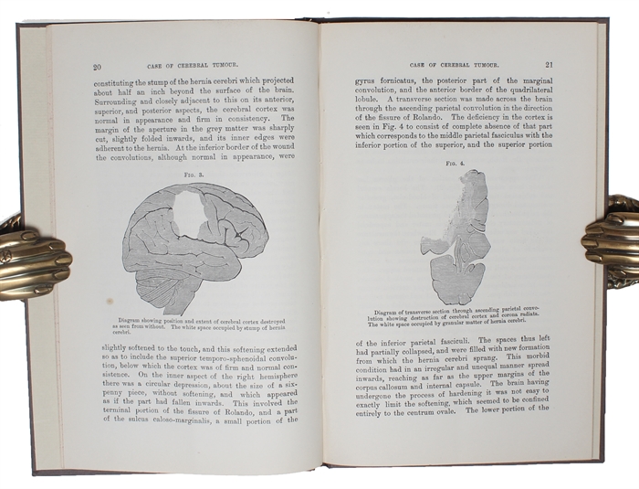 Case of Cerebral Tumor. Read May 12th, 1885. [Offprint from "Medico-Chirurgical Transactions", Vol. 68].
